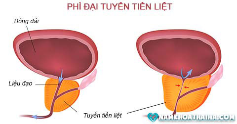 Phì đại tuyến tiền liệt