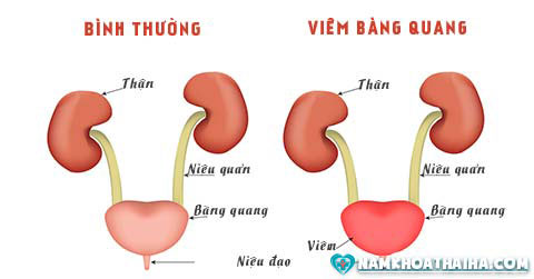 dấu hiệu, triệu chứng viêm bàng quang