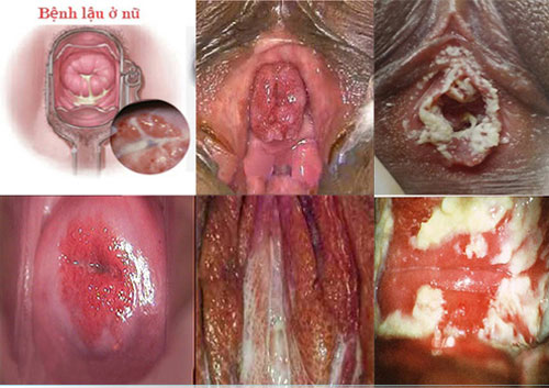 Bệnh lậu ở nữ giới giai đoạn đầu