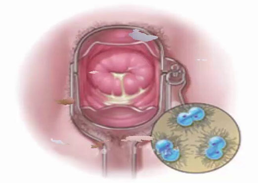 Bệnh lậu ở phụ nữ