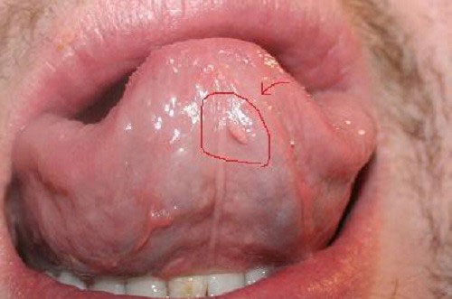 sùi mào gà giai đoạn đầu ở miệng lưỡi