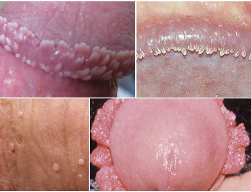 Sùi mào gà ở nam