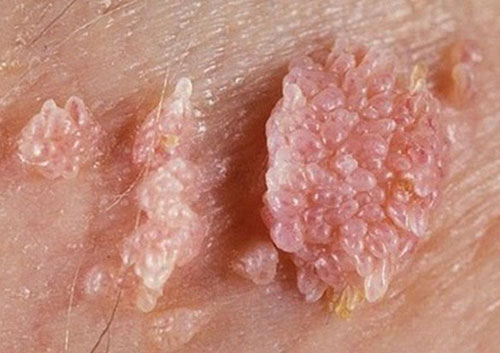 Bệnh sùi mào gà