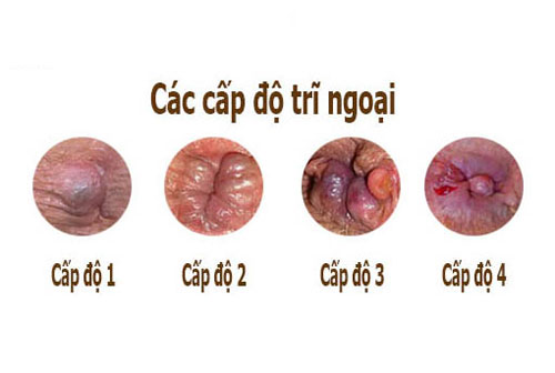 Trĩ ngoại qua 4 cấp độ