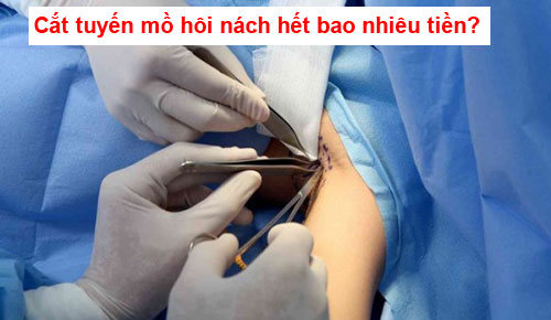 Phẫu thuật cắt tuyến mồ hôi nách trị hôi nách hết bao nhiêu tiền?