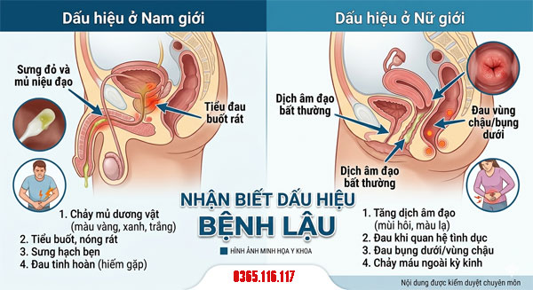 Dấu hiệu bệnh lậu ở nam giới và phụ nữ