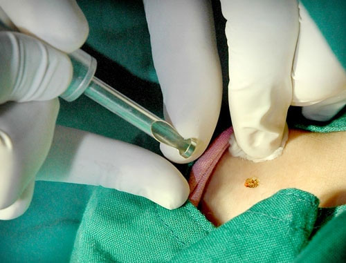 đốt sùi mào gà