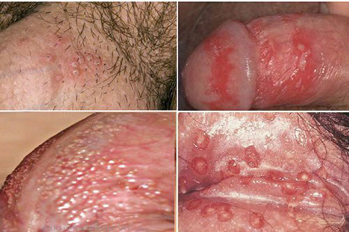 Dương vật nổi mụn