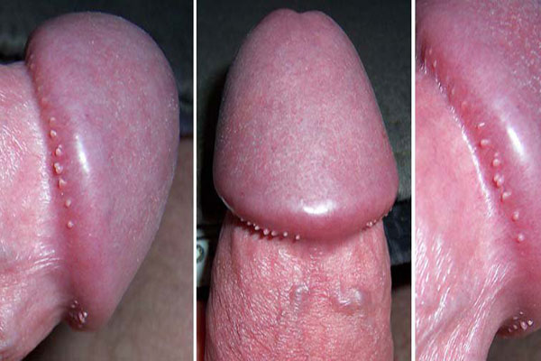 hình ảnh gai sinh dục