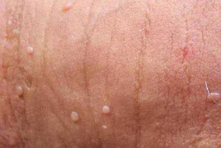 Hình ảnh sùi mào gà giai đoạn đầu