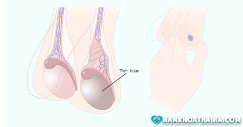 Những bệnh lý nam khoa ở tinh hoàn