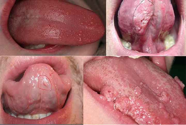 Sùi mào gà ở miệng lưỡi: Hình ảnh/Triệu chứng và cách chữa