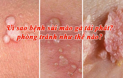 Sùi mào gà tái phát