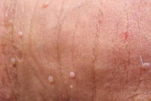 Bệnh sùi mào gà nhẹ có biểu hiện là gì? Có tự khỏi không và cách điều trị hiệu quả