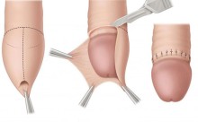 Quy trình cắt bao quy đầu như thế nào, những lưu ý trước và sau tiểu phẫu