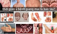 Thời gian ủ bệnh giang mai là bao lâu?