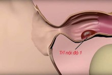 Trĩ nội độ 1 là gì? Có nguy hiểm không và cách chữa trị tại nhà hiệu quả