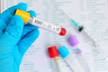Virus hsv là gì, xét nghiệm hsv ở đâu?