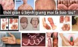 Thời gian ủ bệnh giang mai là bao lâu?