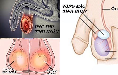 Tinh hoàn nổi cục cứng