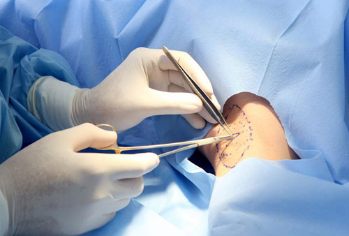 trị hôi nách bằng phương pháp ngoại khoa