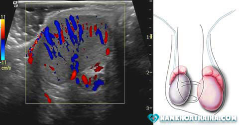 Viêm tinh hoàn ( hình ảnh siêu âm )