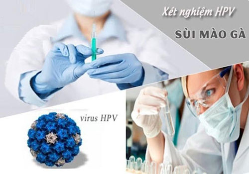 Xét nghiệm sùi mào gà